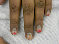 Chemotherapy (cyclophosphamide) transverse nail pigmentation